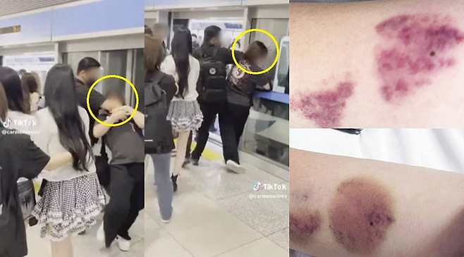 ▲걸그룹 '하츠투하츠'의 경호원이 셔틀 트레인 근처의 일반 승객을 팔꿈치로 가격하는 장면과 피멍이 든 부위. 사진=틱톡·엑스