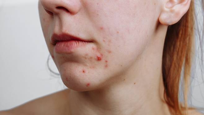 성인 여드름은 특정 부위에 반복해서 나타나는 경향이 있다｜출처: 게티이미지뱅크
