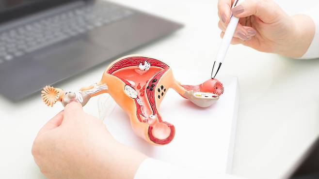 다낭성난소증후군은 단순 생리불순이 아닌 호르몬 대사질환으로 봐야 한다｜출처: 클립아트코리아