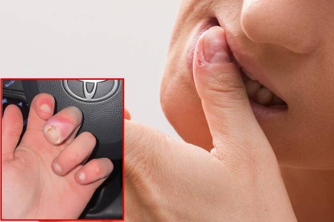 습관적으로 손톱을 물어뜯는 행동은 가벼운 버릇처럼 여겨지기 쉽지만, 손톱 주변 피부와 큐티클이 손상돼 감염 위험을 높일 수 있다. 배경사진=게티이미지뱅크/좌측 하단 사진=SNS