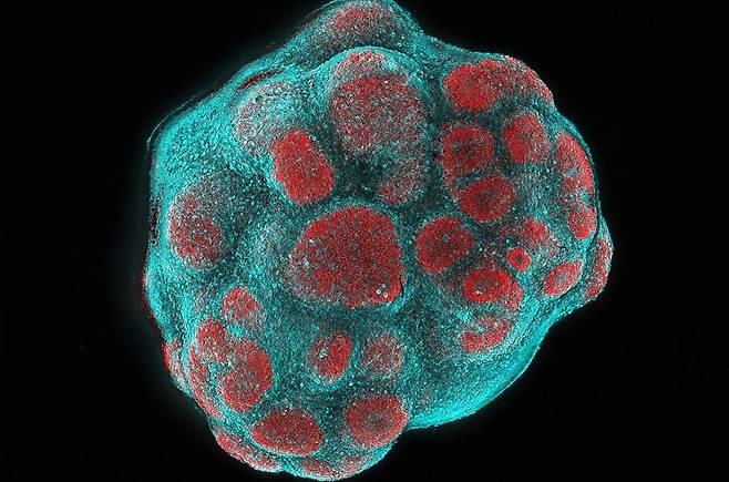 리 증후군 환자의 뇌 오가노이드. 전구세포(빨간색)와 신경세포(파란색). 유전자 돌연변이로 신경세포가 감소했지만, 발기부전 치료재 성분인 실데나필를 복용하자 비율이 회복되면서 오가노이드 성장을 유도했다./Stephanie Le