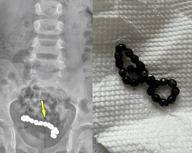 복통을 호소하던 남아의 뱃속에서 자석 뭉치가 발견된 사례가 보고됐다. 출처=큐레우스