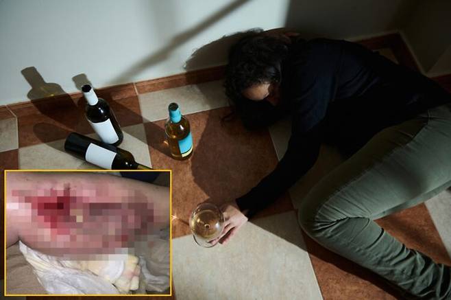 술을 마신 뒤 의식을 잃고 쓰러졌다가 하룻밤 사이 다리가 심하게 부어 오르는 급성 응급상황을 겪은 한 여성이 자신의 경험을 공개하며 과도한 음주의 위험성을 경고했다. 배경사진=게티이미지뱅크 / 하단=본인 SNS