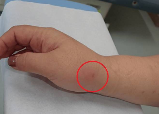 고양이 물림으로 오른쪽 손에 생긴 상처. 사진=큐레우스(Cureus)