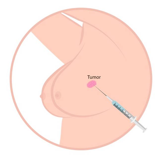 유방암 환자를 위한 종양 치료 이미지. 종양 내 주사로 시작된 면역 반응이 전신으로 확산될 가능성이 제기됐다. 사진=게티이미지뱅크