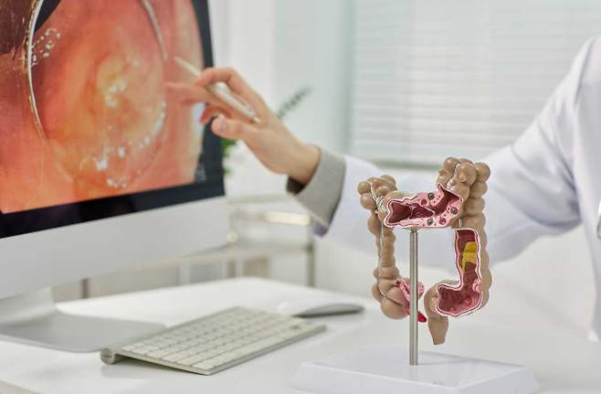 최근 국내 50세 미만 젊은 대장암 발생률은 정체하고 있으나 검진 시작 연령을 낮추고 검진, 진단, 치료로 이어지는 검진 사슬을 마련하는 등 정밀한 대책 마련이 필요하다./사진=클립아트코리아