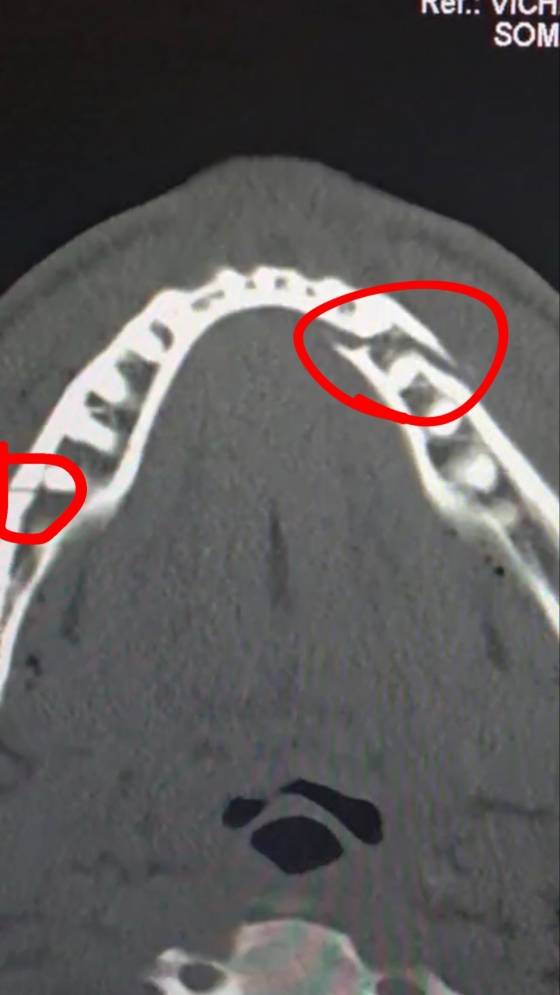 제이크 폴이 조슈아와 경기 후 공개한 턱뼈 골절 엑스레이. /사진=제이크 폴 개인 사회관계망서비스(SNS)