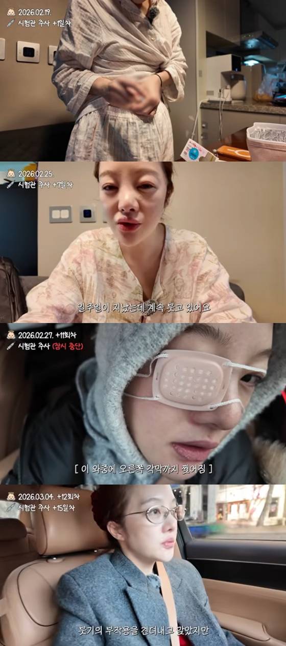 42세 황보라, 시험관 주사 부작용으로 얼굴 '퉁퉁'..각막까지 손상 "만신창이"