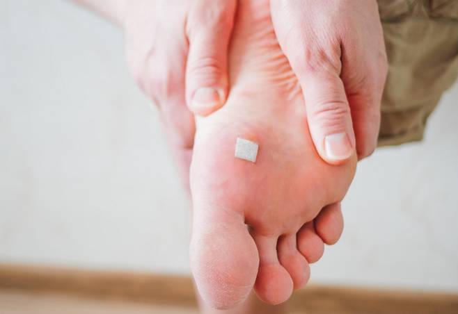 '티눈' 치료를 위해 7년간 2500회 넘는 시술을 받고 7억원대 보험금을 타낸 40대를 상대로 보험사가 계약 무효 소송을 냈지만, 대법원은 보험 가입자의 손을 들어줬다. /사진=게티이미지뱅크