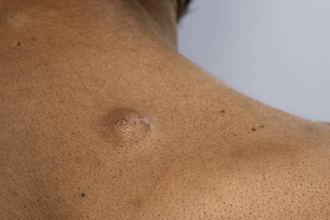 (위 사진은 기사 내용과 직접적인 관련이 없음.)지방종은 우리 몸의 지방조직 속 지방세포가 비정상적으로 증식해 발생하는 양성 종양이다.​/사진=클립아트코리아