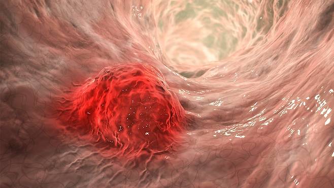 대장내시경은 단순 진단을 넘어 치료와 예방 효과까지 겸비한 검사이다｜출처: 클립아트코리아