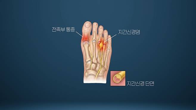 지간신경염/서울경제TV ‘지금 명의’ 캡처