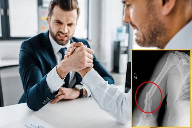 팔씨름 도중 상완골(위팔뼈)이 골절되는 사례가 보고됐다. 배경사진=게티이미지뱅크/우측 하단 사진=Cureus