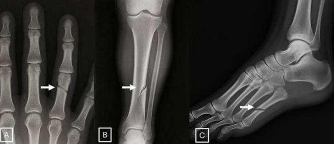 AI가 생성한 가짜 엑스레이. AI 진단 모델의 학습 데이터에 섞여 들어가면 진단 정확도를 떨어뜨릴 수 있다. 북미영상의학회(RSNA) 제공