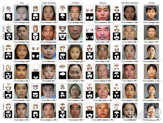 피부 질환 임상 사진 적용 사례. 환자의 신원은 보호하면서도 진단에 필수적인 피부 병변(여드름, 건선 등)은 훼손 없이 보존했다.(서울대병원 제공)