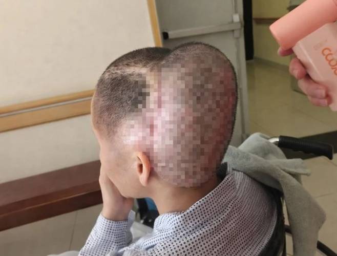 관자놀이에 자가지방을 이식하는 시술을 받은 30대 여성이 지방 색전증으로 인한 뇌경색과 두개골 결손이라는 비극적인 부작용을 겪은 사연이 전해졌다./사진=Z news