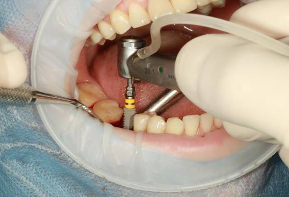 특히 임플란트 시술을 받았을 경우 안 좋은 생활 습관에 유의해야 한다. 사진은 본 기사 내용과 무관.  [사진=픽사베이@ volodymyr007]