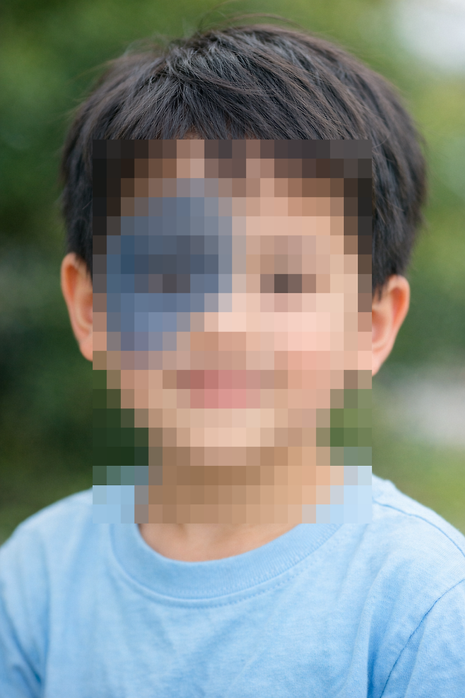 선천성 오타모반 어린이.[챗GPT 생성]