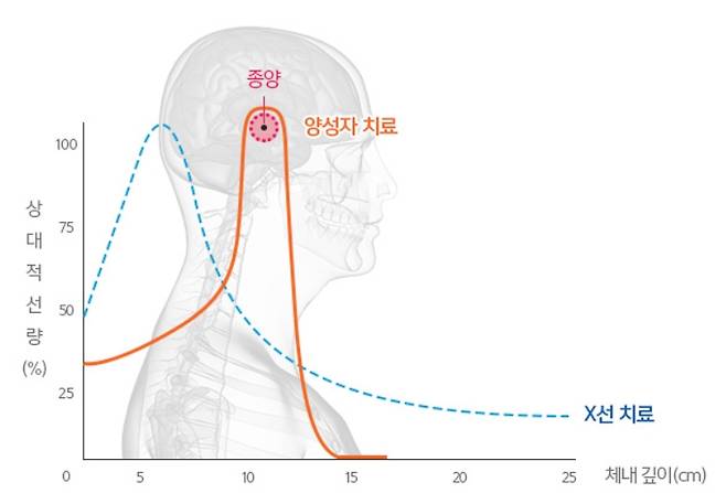 양성자 치료의 핵심 원리인 브래그피크를 설명한 그래프. /자료=삼성서울병원