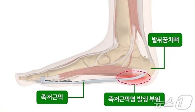 족저근막의 위치. (질병관리청 제공)