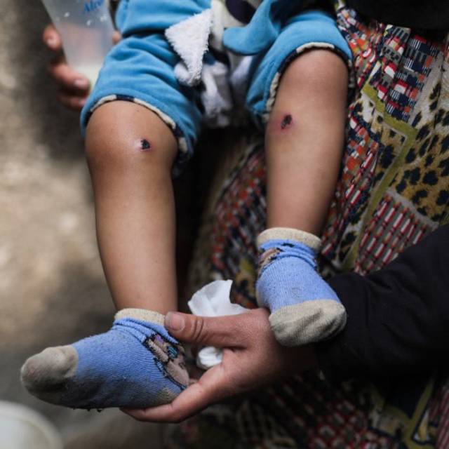 ▲팔레스타인 자치정부 유엔 대표부가 자신의 2026년 3월 28일 자신의 X 계정에 올린 18개월 아동 자와드의 다리 사진. ⓒX(@Palestine_UN)