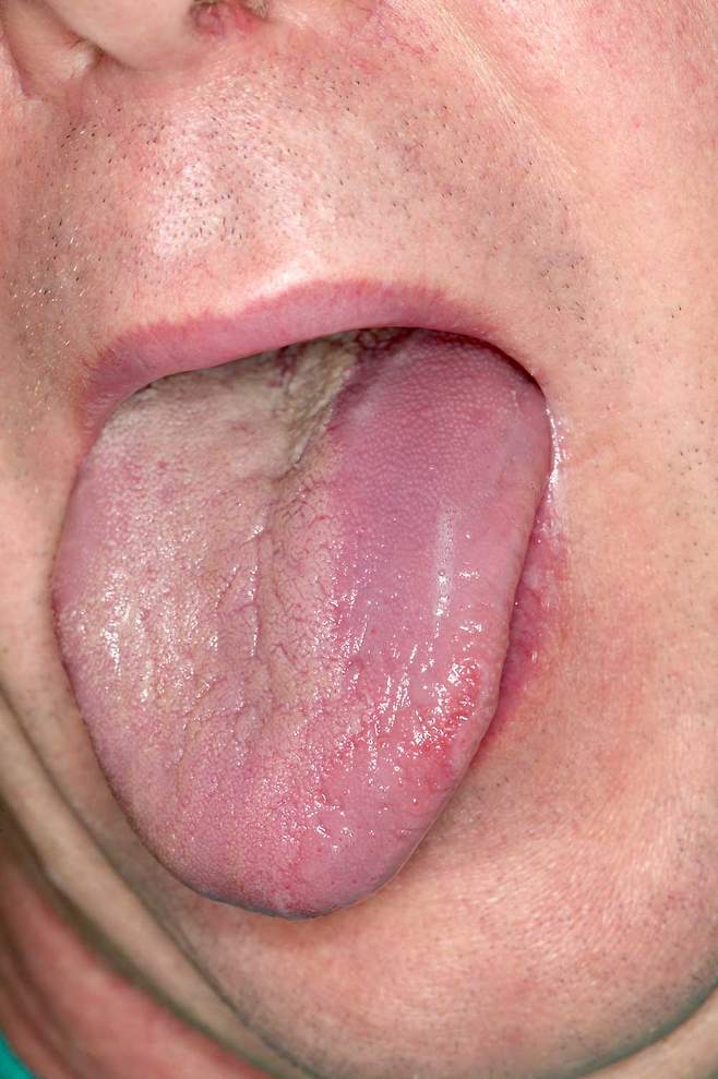 정상적인 혀 색깔은 엷은 붉은색이다. 혀 색에 변화가 생겼다면 건강에 이상이 생겼을 수 있다. /클립아트코리아