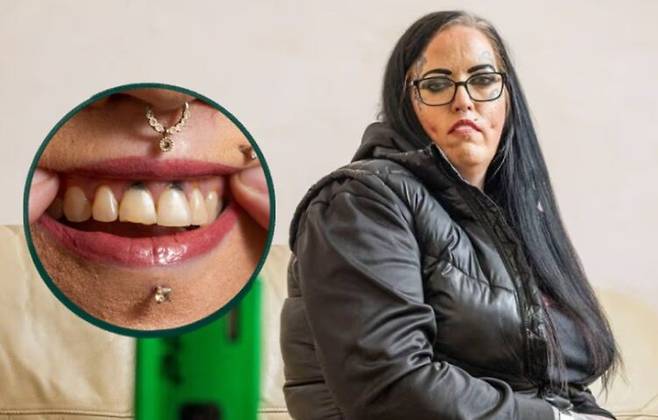 영국 여성 스테이시 가디너는 전자담배를 오래 사용하면서 치아가 검게 변색됐다. 사진=더미러