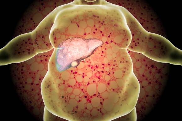지방간. 사진은 본 기사 내용과 무관함. [사진=Rocky Mountain Gastroenterology]