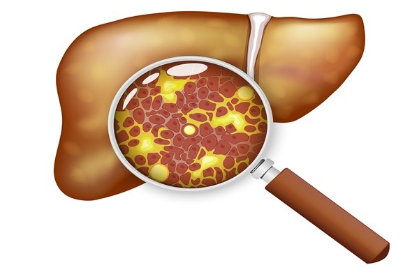 대사이상 지방간질환이 있는 20~30대의 신장암 발병 위험이 지방간이 없는 사람보다 높다는 연구 결과가 발표됐다. 게티이미지