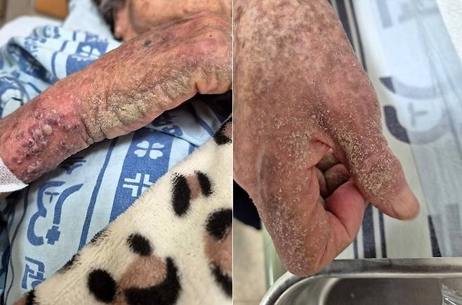 옴 감염으로 피부 상태가 심하게 악화한 모습 [A씨 유족 측 제공. 재판매 및 DB 금지]