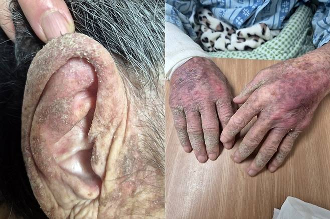 옴 감염으로 피부 상태가 심하게 악화된 모습 [A씨 유족 측 제공. 재판매 및 DB 금지]