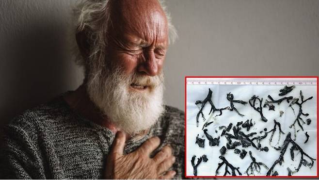 산불 연기를 들이마신 뒤 호흡곤란을 호소하며 병원을 찾은 80대 남성의 기관지와 폐에서 검은색 덩어리가 다수 발견된 사례가 보고됐다. 배경사진=게티이미지뱅크/우측 하단 사잔=뉴잉글랜드의학저널