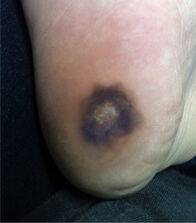 발바닥에 발생한 흑색종. 서울대학교병원
