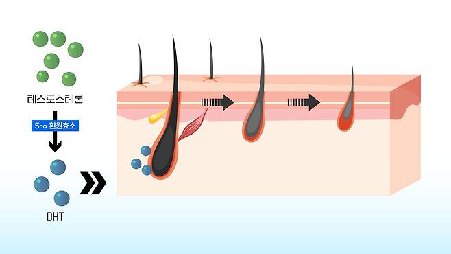 남성호르몬인 테스토스테론은 효소에 의해 DHT로 변환된다. 이 DHT가 모낭을 공격해 머리를 빠지게 만든다. 하지만 모든 사람이 DHT의 공격에 취약한 것은 아니고 탈모 유전자가 있는 사람만 영향을 받는다. 이민서 그래픽.