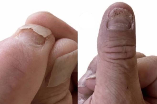 수족구병 합병증으로 손톱이 박리된 60대 남성의 손. 사진=큐레우스(Cureus)