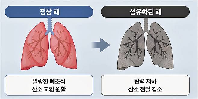 정상 폐와 섬유화된 폐의 특징. /그래픽=최우연