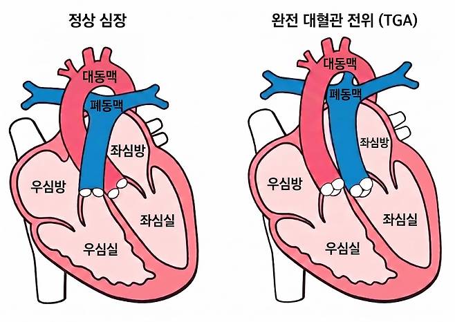 정상 심장과 완전 대혈관 전위./사진=서울대병원 제공