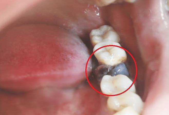 40대 여성 잇몸에 발생한 구강 악성 흑색종. 사진=큐레우스(Cureus)