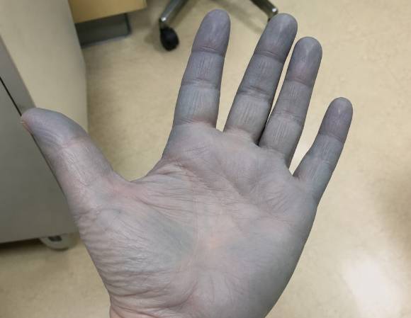 흔히 처방되는 항생제를 복용한 뒤 피부와 혀가 푸른빛으로 변한 여성 환자 사례가 국제 학술지에 보고됐다. 사진은 AI 생성 이미지로, 본 기사 내용과 무관. [사진=챗GPT]