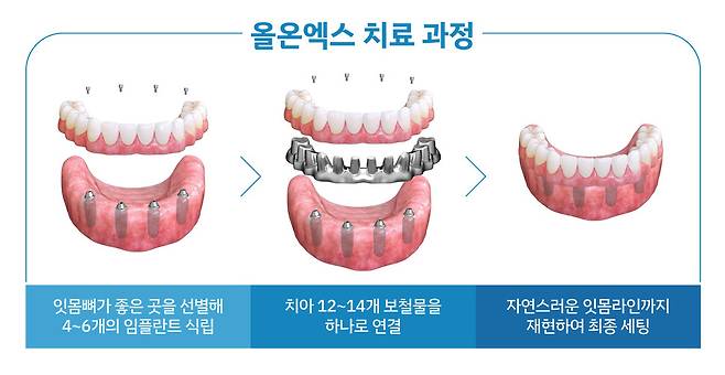 올온엑스 치료 과정.