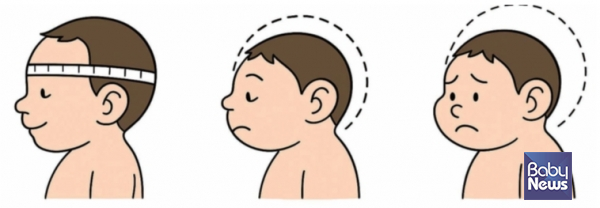 소두증은 같은 나이와 성별의 아이들과 비교했을 때 머리둘레가 작은 상태를 의미한다. ⓒ임신영