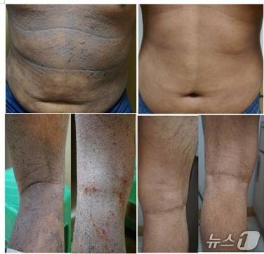 중증아토피피부염 환자의 치료 경과 사진. (한림대의료원 제공)