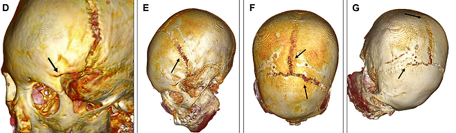 CT 촬영 결과 둔기로 맞은 흔적이 발견됐다. [국제학술지 사이언스 어드밴시스(Science Advances) 제12권 제29호]