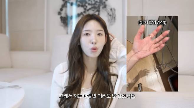 Lee Na-yeon, a JTBC sports announcer and cast member of Transfer Love 2, revealed on her YouTube channel that she experienced severe hair loss as a side effect of her hair transplant surgery. Lee Na-yeon said she suffered significant emotional distress after the surgery due to massive hair loss at the back of her head, but she has now recovered to a large extent.She underwent a non-surgical long-hair transplant to correct her receding hairline, but starting ten days after the procedure, she began losing handfuls of hair from the back of her head—not from the transplanted area. Although she visited several hospitals without finding a clear cause, she described the situation at the time as hellish and opened up about her emotional state, revealing that she would often shed tears while looking in the mirror.Based on this experience, Lee Na-yeon emphasized the importance of managing scalp health before surgery to those considering a hair transplant. She also urged people to make careful decisions, noting that such side effects could stem from complex factors—such as an individuals immune response—rather than being due to the clinics negligence.