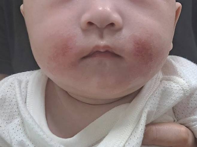 침독 증상이 나타난 아이./사진=임신영 원장 제공