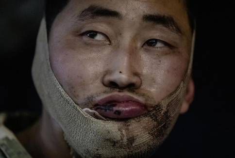 우크라이나군이 러시아 쿠르스크에서 생포한 북한군. 얼굴에 붕대를 감고 있다. [볼로디미르 젤렌스키 우크라이나 대통령 텔레그램 캡처. 재판매 및 DB 금지]