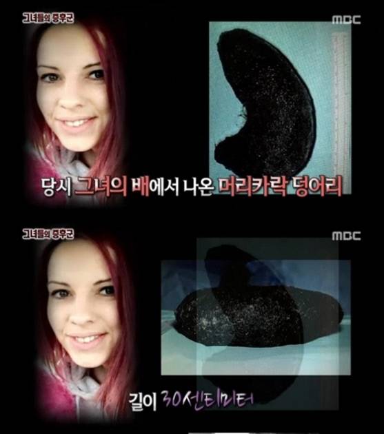 MBC ‘서프라이즈’ 에서 라푼젤 증후군을 다뤘다.