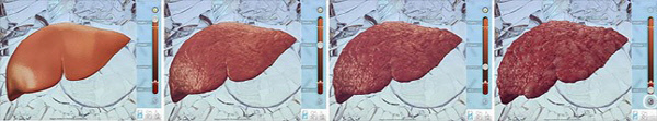 사진 왼쪽부터 정상간, 간섬유화, 간병변, 간암.  <자료 출처: HEPATOSCOPE Application>