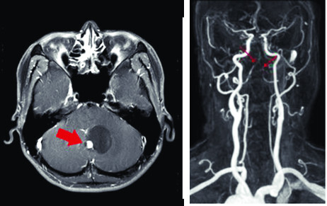 중추신경계의 구조·기능적 이상에 의해서도 어지럼증이 생긴다. 소뇌에 자라는 종양(왼쪽 사진 화살표)과 뇌로 연결되는 목뼈 동맥이 좁아진 모습(오른쪽 사진 화살표)의 MRI 영상. 뇌혈관이 좁아진 상태로 방치하면 뇌경색으로 이어진다.  분당서울대병원·서울아산병원 제공