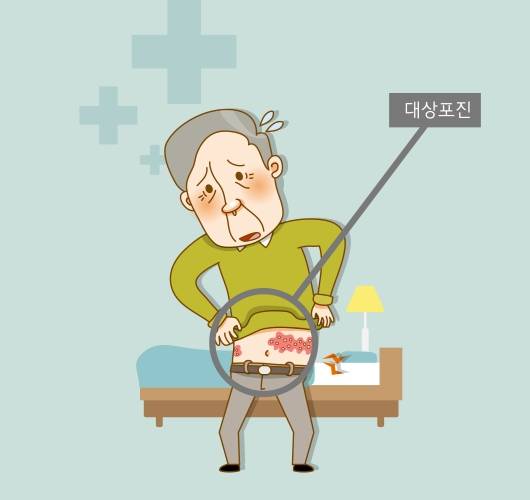 대상포진